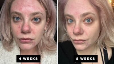 my hormonal acne journey with winlevi the new spironolactone alternative for treating hormonal and cystic acne