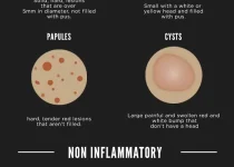 DISCOVER HOW TO CURE ACNE | how to treat each type of acne