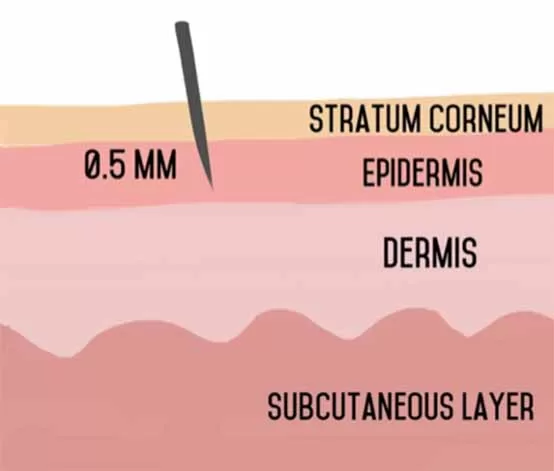 DISCOVER HOW TO CURE ACNE | what is microneedling how it works and all your questions answered