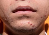 DISCOVER HOW TO CURE ACNE | frustrated by zits follow these proven tips