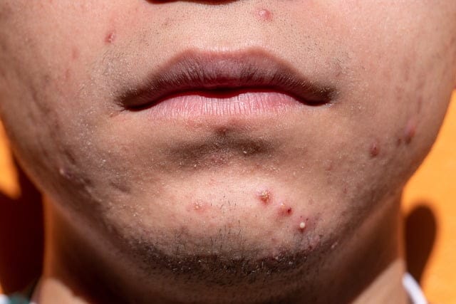 DISCOVER HOW TO CURE ACNE | frustrated by zits follow these proven tips