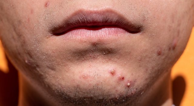 DISCOVER HOW TO CURE ACNE | tips on how to cure pimples quickly