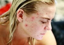 DISCOVER HOW TO CURE ACNE | treat your zits quickly and effectively with these tips