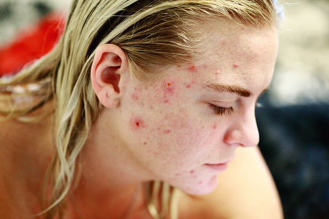 DISCOVER HOW TO CURE ACNE | treat your zits quickly and effectively with these tips