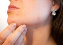 DISCOVER HOW TO CURE ACNE | clear your acne up with simple steps