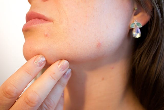 DISCOVER HOW TO CURE ACNE | clear your acne up with simple steps