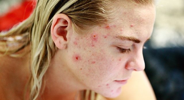 DISCOVER HOW TO CURE ACNE | tips and tricks for eliminating your pimples woes