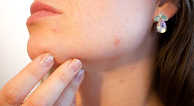 DISCOVER HOW TO CURE ACNE | clean your skin up today with these tips