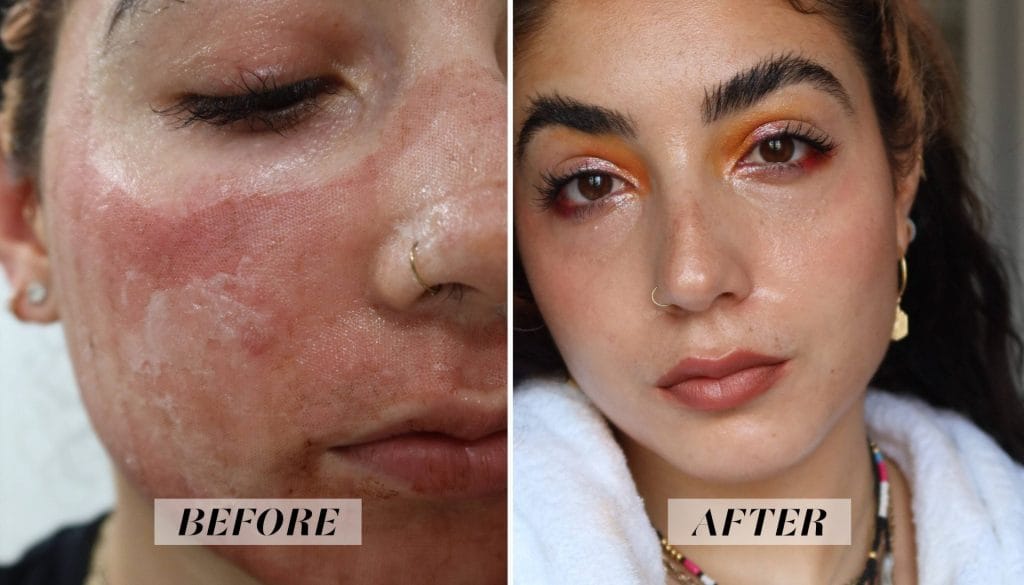 DISCOVER HOW TO CURE ACNE | i tried fractional co2 laser treatment and im amazed by the results see photos