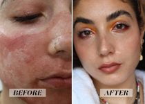 DISCOVER HOW TO CURE ACNE | i tried fractional co2 laser treatment and im amazed by the results see photos