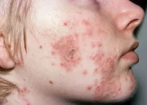 DISCOVER HOW TO CURE ACNE | picture of cystic acne