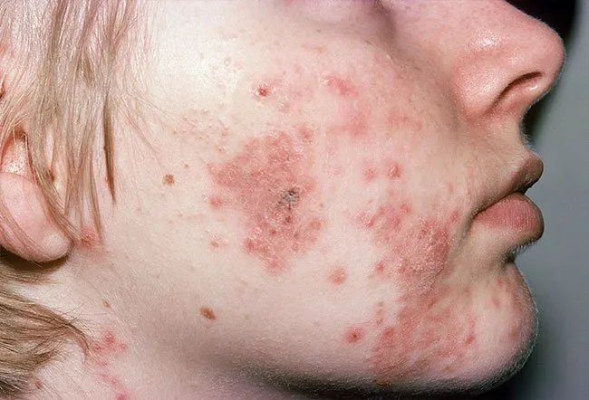 DISCOVER HOW TO CURE ACNE | picture of cystic acne