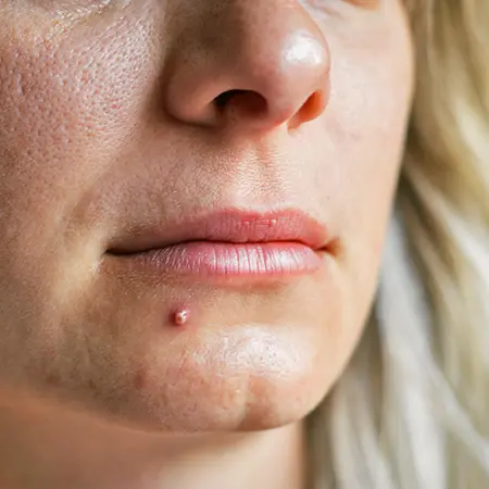 DISCOVER HOW TO CURE ACNE | pimple vs cold sore