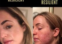 DISCOVER HOW TO CURE ACNE | 8 acne stories that made us tear up my acne story