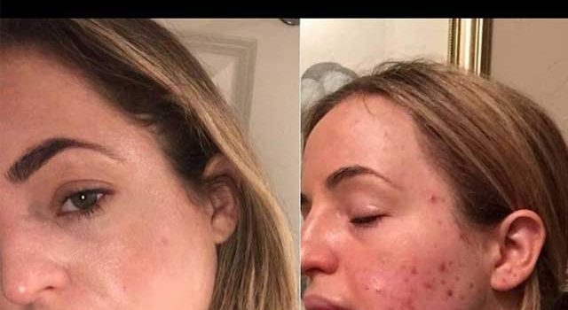 DISCOVER HOW TO CURE ACNE | 8 acne stories that made us tear up my acne story