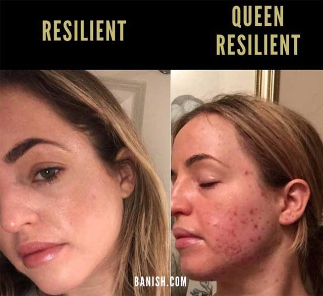 DISCOVER HOW TO CURE ACNE | 8 acne stories that made us tear up my acne story