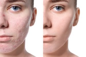 Acne-Treatments: Causes and Prevention