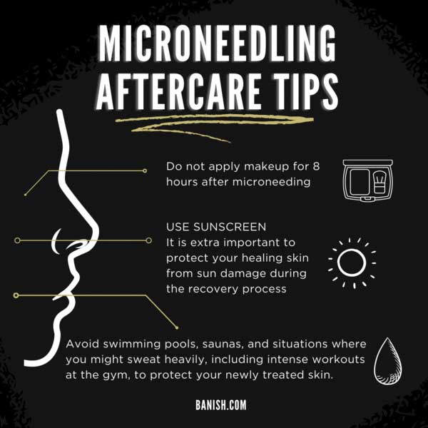 DISCOVER HOW TO CURE ACNE | how to care for your skin after microneedling dos and donts