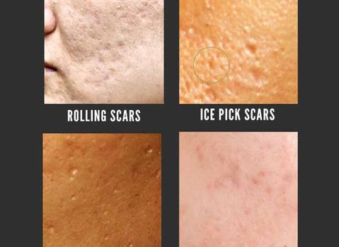 DISCOVER HOW TO CURE ACNE | how to get rid of acne scars fast heres what works