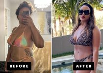 DISCOVER HOW TO CURE ACNE | my experience with liposuction and a tummy tuck as a patient with brown skin review with before after photos