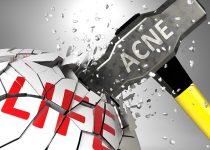 DISCOVER HOW TO CURE ACNE | reliable acne advice you can use today