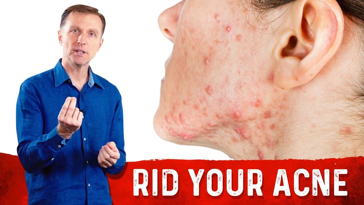 DISCOVER HOW TO CURE ACNE | rootF IMG 66d4449f7289d