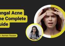 DISCOVER HOW TO CURE ACNE | rootF IMG 66dc53a28c658