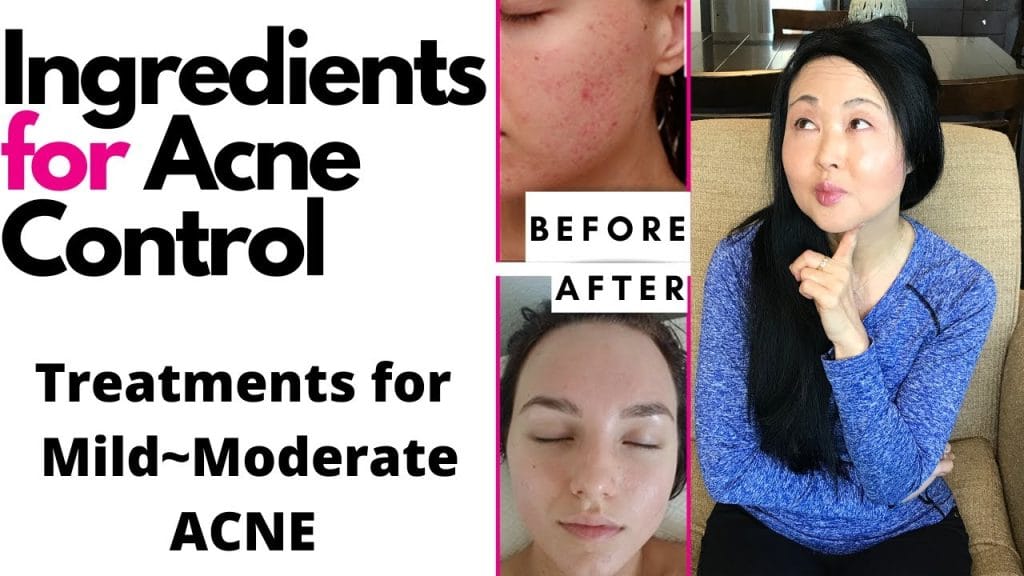 DISCOVER HOW TO CURE ACNE | rootF IMG 66dc54ed9aeda