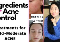 DISCOVER HOW TO CURE ACNE | rootF IMG 66dc54ed9aeda